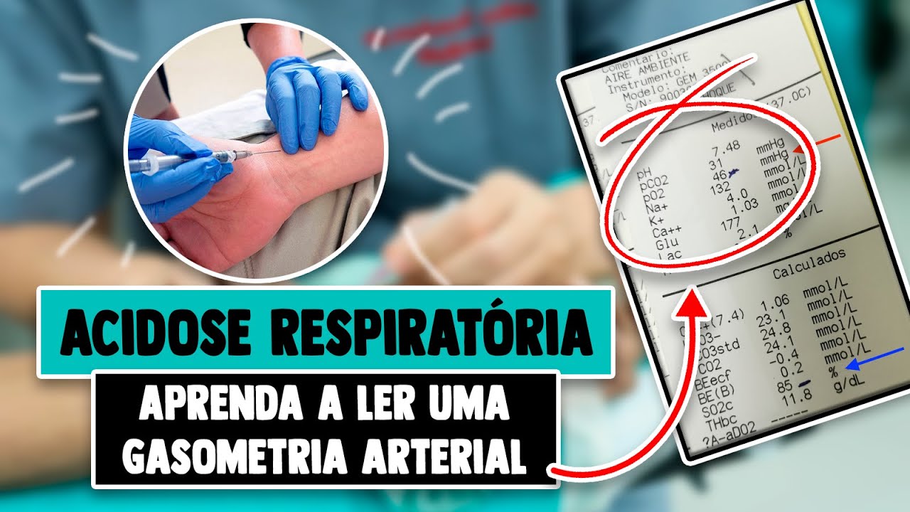 GASOMETRIA Arterial de uma Acidose Respiratória │ Medicina Resumida