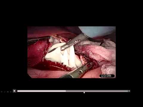  Laparoscopic Management of Hydatid Cyst 