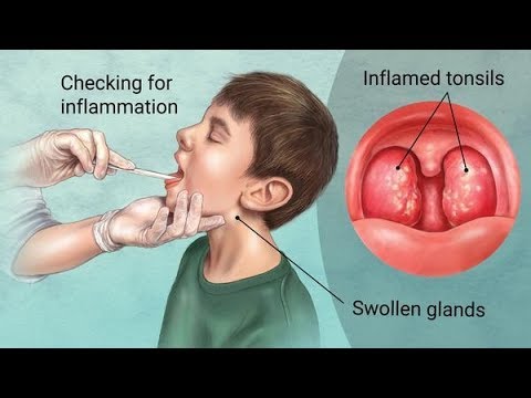 Kenali Penyebab Dan Gejala Amandel Membengkak Antar Herbal Video