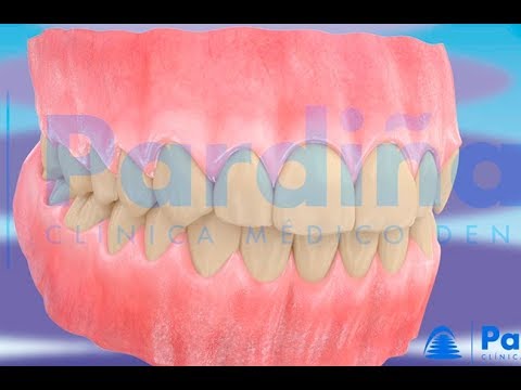 Branqueamento dental ©