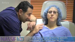 Revision Rhinoplasty Experience - Alyssa | Dr. Paul Nassif