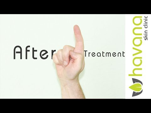 download lagu mp3 mp4 Laser Hair Removal Shedding, download lagu Laser Hair Removal Shedding gratis, unduh video klip Laser Hair Removal Shedding