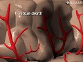 How Stroke Happens Animation How Strokes Affect The Brain Video