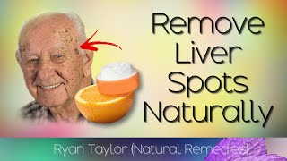 Remove Liver Spots Naturally (Age Spots Natural Remedies)