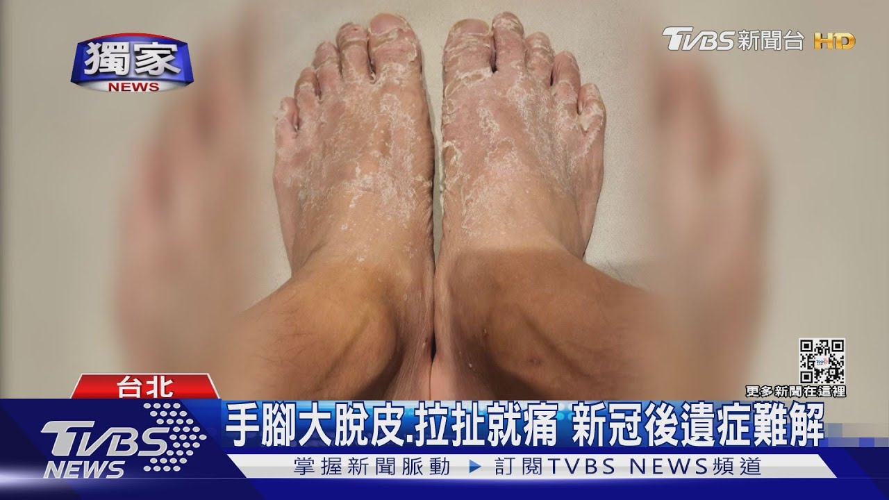 台灣新冠後遺症患者上看20萬!新變異株致病力升 美國準備「這個」對抗