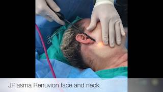 Neck Lift Richmond