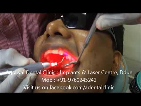 Laser Dentistry
