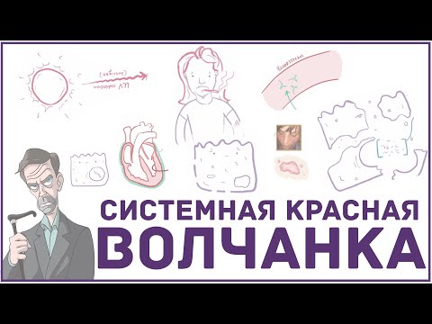 Системная красная волчанка - причины, симптомы, диагноз и патология