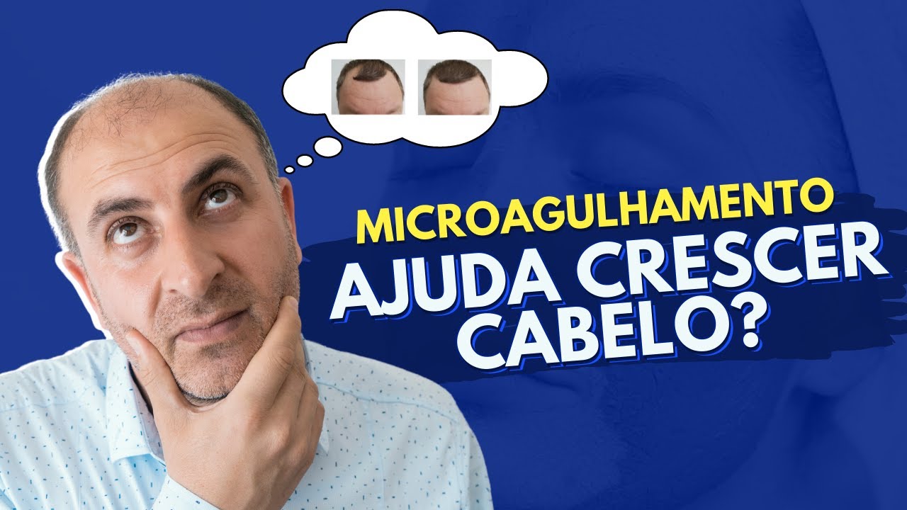Microagulhamento Para Crescer Cabelo Funciona?