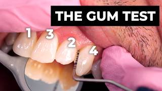 The Secret Gum Test Hygienists Do Every Visit