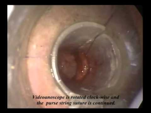 Sted Hemorrhoidopexy with the Videoanoscope: First in the world