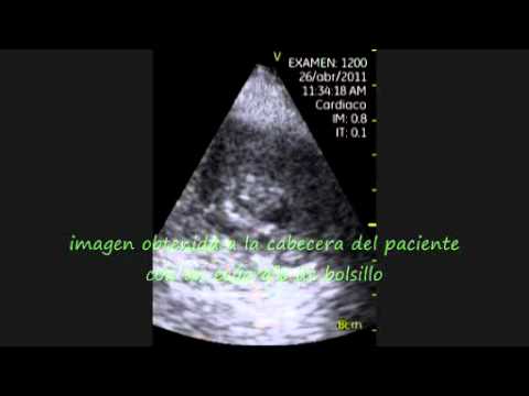 Thrombus In Left Ventricular Aneurysm