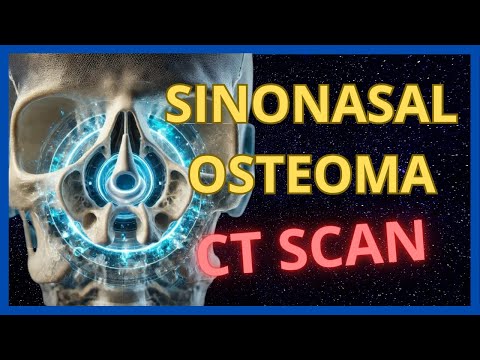 Sinonasal Osteoma: Key Radiological Findings 🧠👃