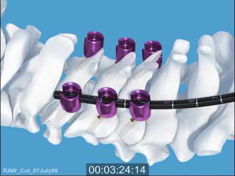 DepuySynthes: Synapse
