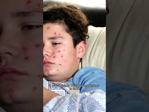 How deadliest the Variola Virus