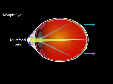Szemészeti retina degeneráció