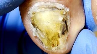 An 83 Year Old Patient Has Strange Onychomycosis!【Xue Yidao】