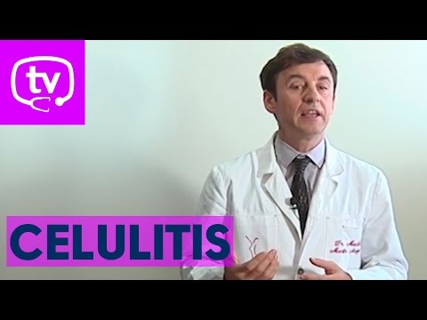 La celulitis ¿tiene solución?