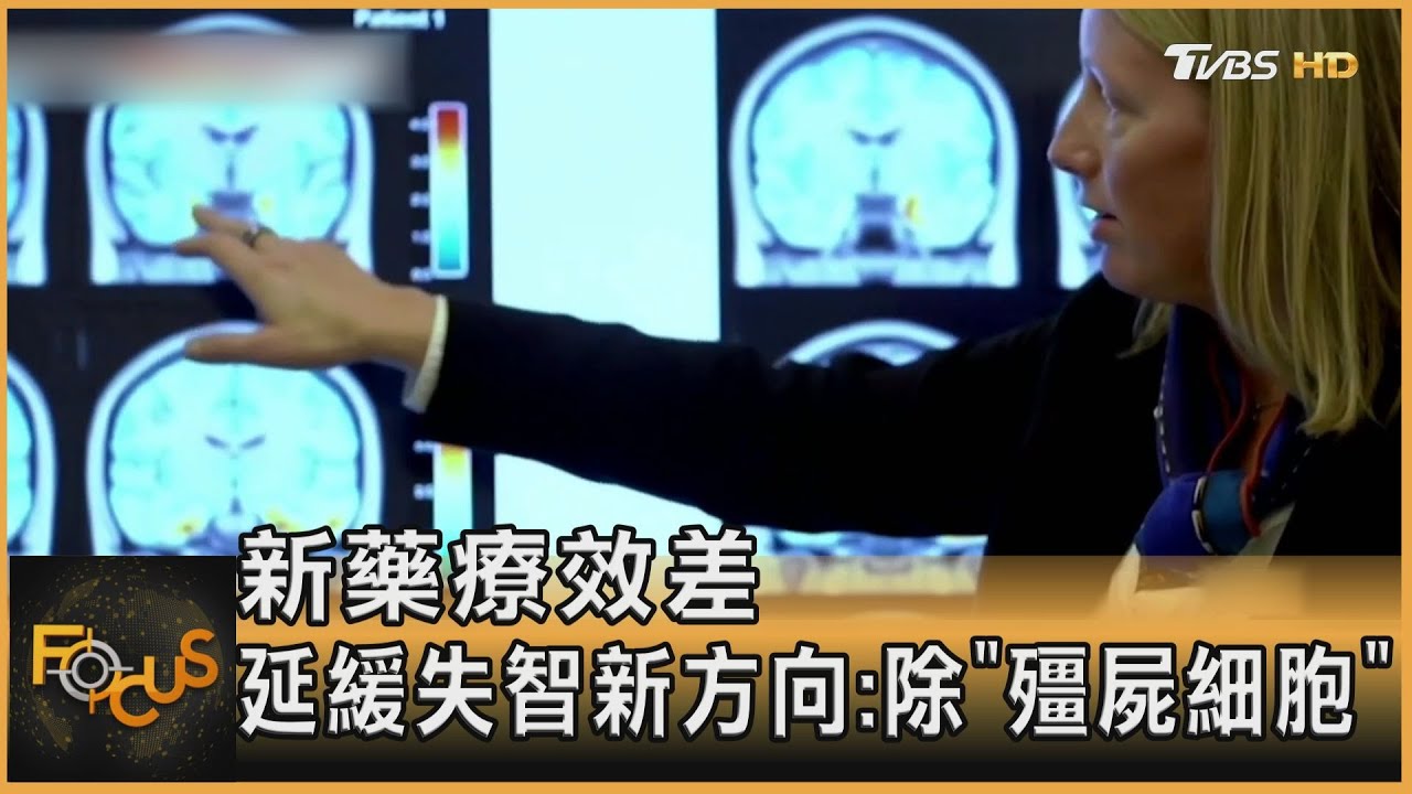 新藥療效差 延緩失智新方向:除「殭屍細胞」
