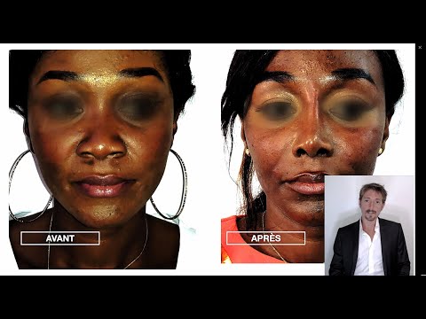 Rhinoplastie ultrasonique : principes et résultats possibles