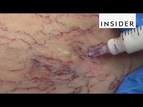 How Doctors Get Rid of Spider Veins
