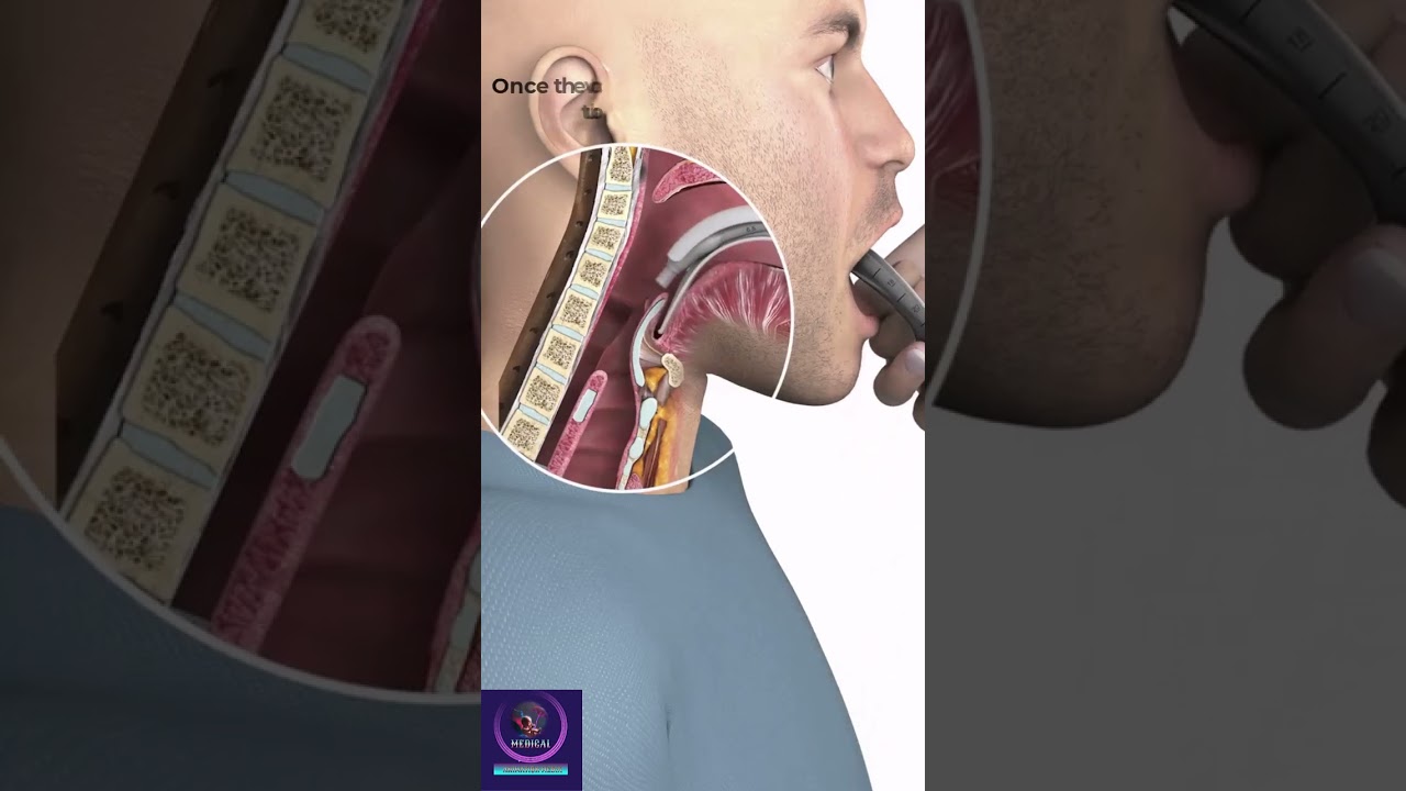 Endotracheal Intubation #education #shorts