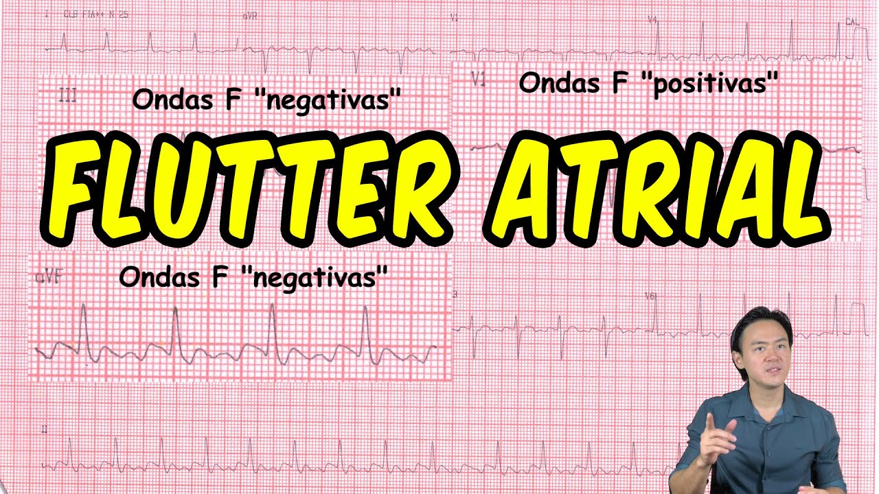Eletrocardiograma - análise - flutter atrial