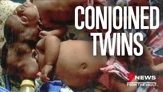 The heartwarming story of Trishna & Krishna: Conjoined twins separated