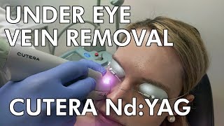 Under Eye Vein Removal: Cutera Nd:YAG Laser - Dr. Paul Ruff | West End Plastic Surgery