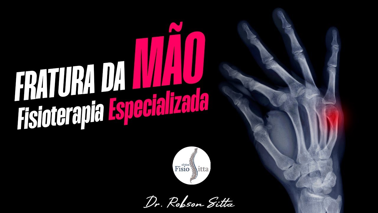 FRATURA DO BOXER - QUINTO METACARPO DA MÃO - FISIOTERAPIA ESPECIALIZADA com Dr. Robson Sitta