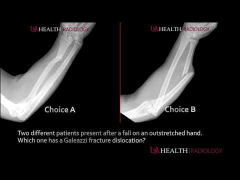 Galeazzi Versus Monteggia Fracture Dislocations