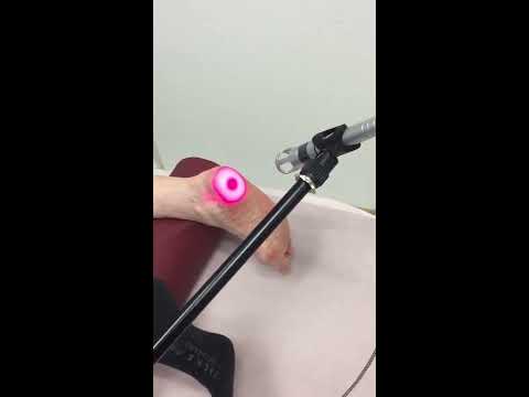 Fersensporn Behandlung. Med. Lasertherapie Reutlingen / Stuttgart