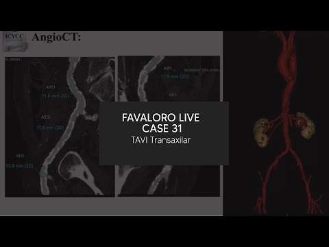 Favaloro Live Case N° 31 - TAVI Transaxilar