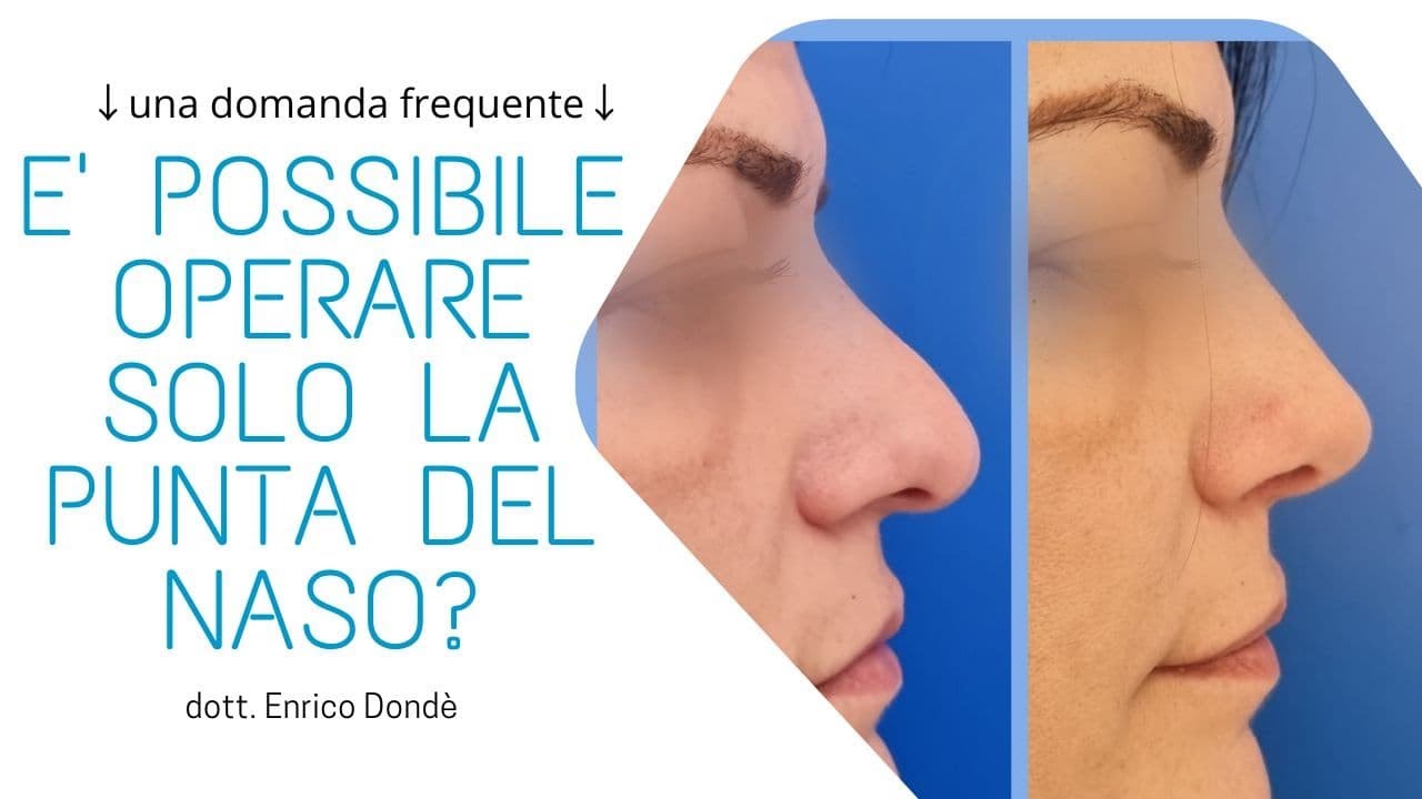 👃 E' possibile operare solo la punta del naso | dr. Enrico Dondè