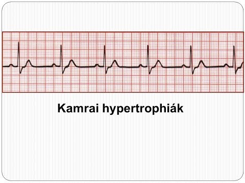 a magas vérnyomás EKG-jának dekódolása)
