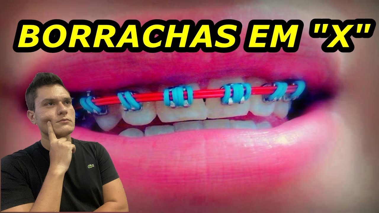 Watch Now BORRACHINHAS DO APARELHO ORTODÔNTICO EM FORMATO DE X | PRA QUE SERVEM | QUANDO SÃO USADAS BORRACHINHAS DO APARELHO ORTODÔNTICO EM FORMATO DE X | PRA QUE SERVEM | QUANDO SÃO USADAS