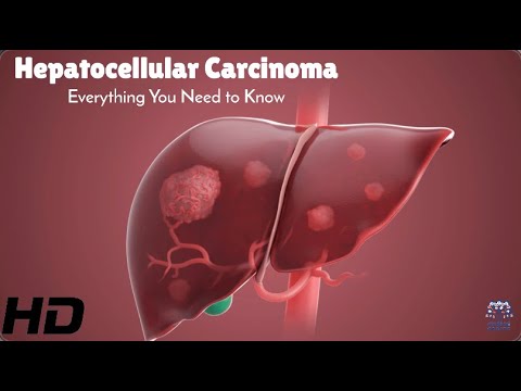 Fighting Hepatocellular Carcinoma: Key Facts