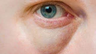 How to Cure Puffy Eyes - Under Eye Bags Home Remedies