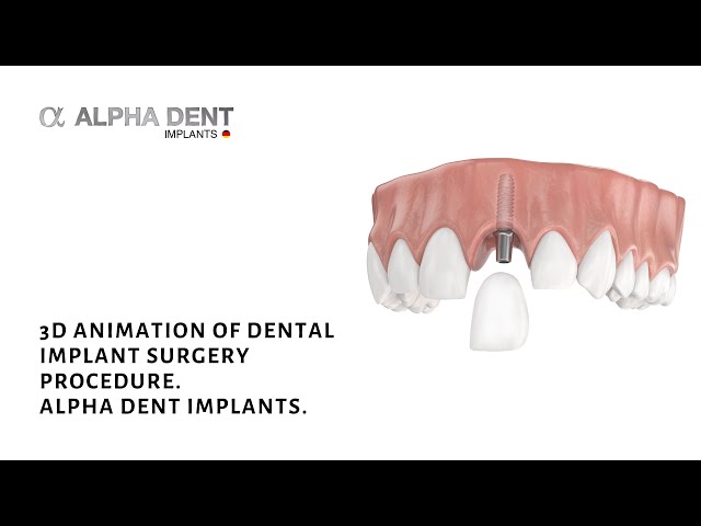 Implant Surgery 3D Animation