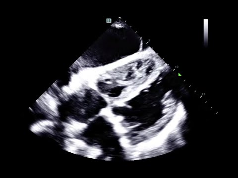 Cardiogenic shock ultrasound. Patient with syncope. 09/2021.