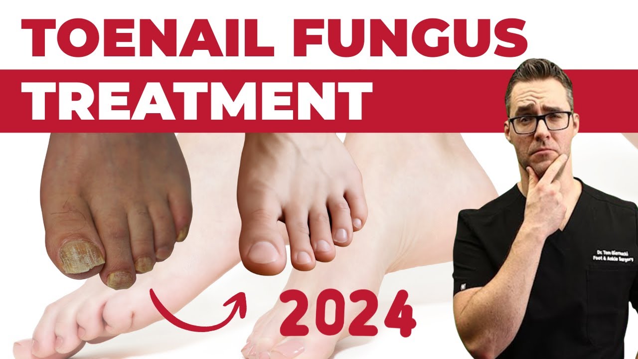 BEST Toenail Fungus Treatment 2024 [+4 BIG SECRETS]
