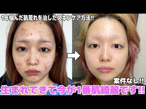 Descargar 繰り返すニキビ肌を改善した最近のスキンケア