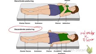 Decerebrate Vs Decorticate Posturing