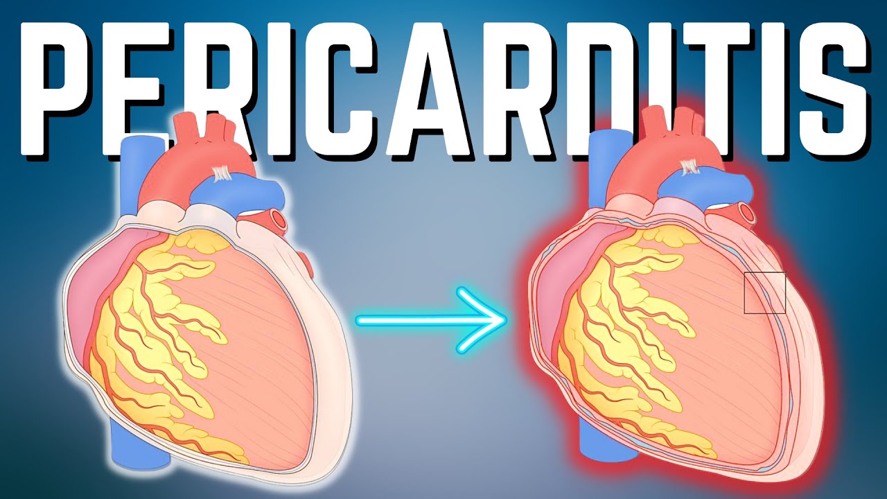 Pericarditis Aguda Explicada Claramente