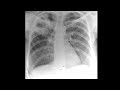 Mayo Clinic Minute: Understanding tuberculosis