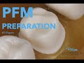 PFM Preparation On The Maxillary First Molar For 3 Kilgore Stevenson Dental Solutions