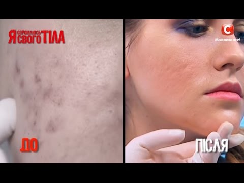 Как ухаживать за кожей лица с веснушками Мазь для отбеливания кожи ног