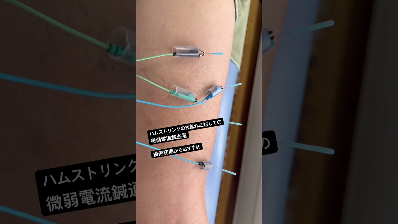 ハムストリングの肉離れに微弱電流鍼通電❗️