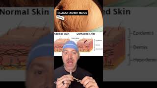 Frustrated with Stretch Marks Try This! #shorts