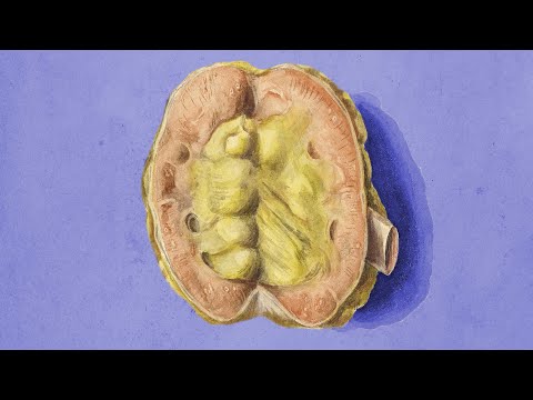 A Dad Mistakenly Drank A Snowglobe. This Is What Happened To His Kidneys.